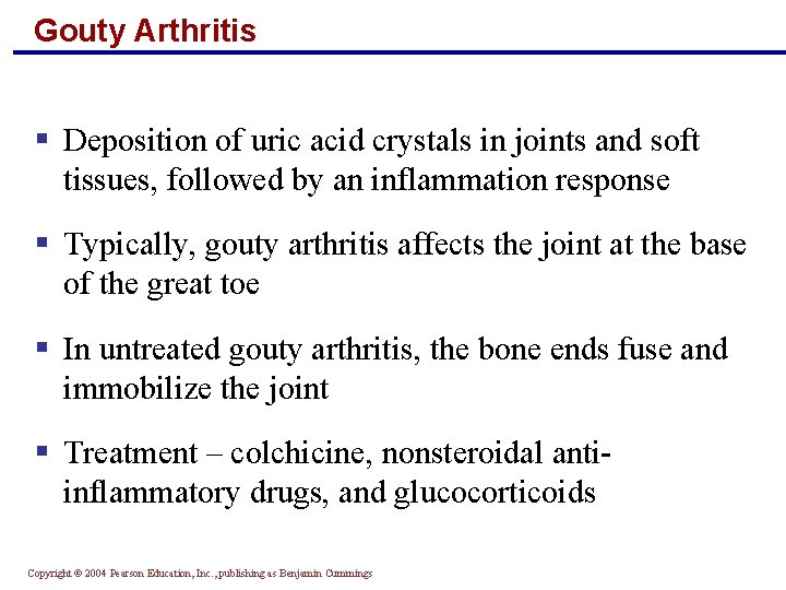 Gouty Arthritis § Deposition of uric acid crystals in joints and soft tissues, followed