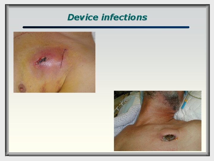 Device infections 