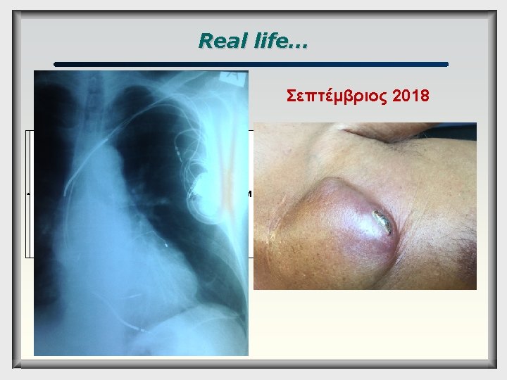 Real life… Σεπτέμβριος 2018 80 Α. Τ. 10/3/2011 1 Medtron Maximo II 9 ic