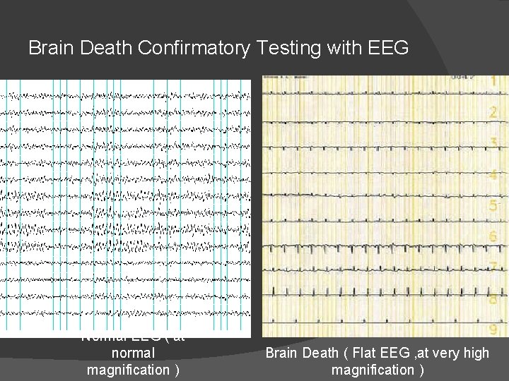 Brain Death Confirmatory Testing with EEG Normal EEG ( at normal magnification ) Brain