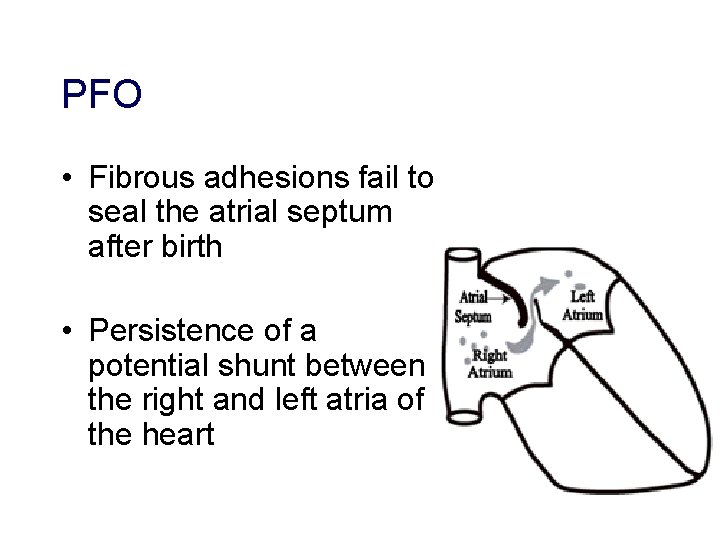 PFO • Fibrous adhesions fail to seal the atrial septum after birth • Persistence