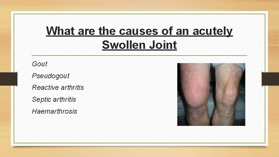 What are the causes of an acutely Swollen Joint Gout Pseudogout Reactive arthritis Septic