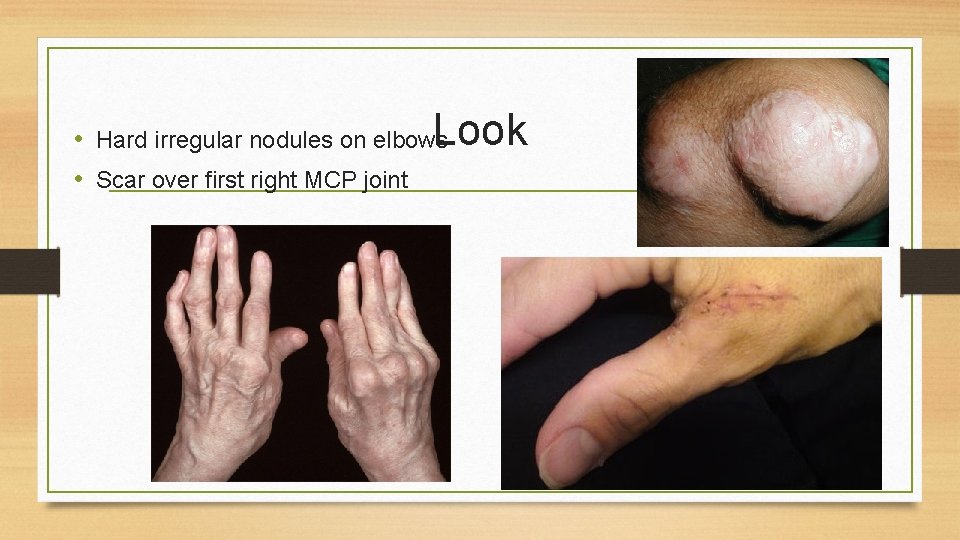 Look • Hard irregular nodules on elbows • Scar over first right MCP joint