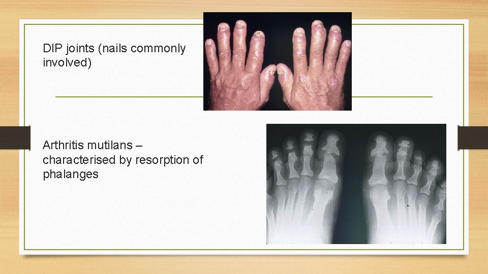 DIP joints (nails commonly involved) Arthritis mutilans – characterised by resorption of phalanges 