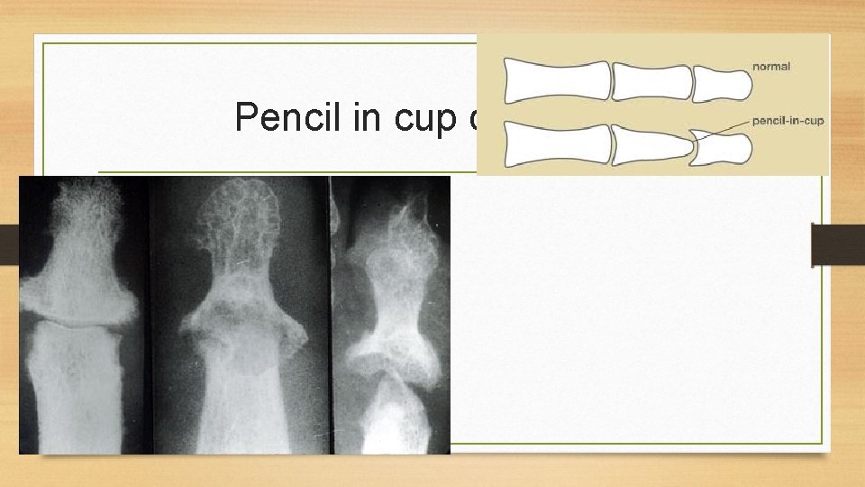 Pencil in cup deformity 