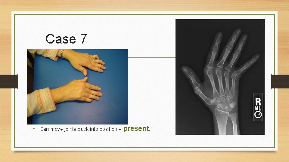 Case 7 • Can move joints back into position – present. 