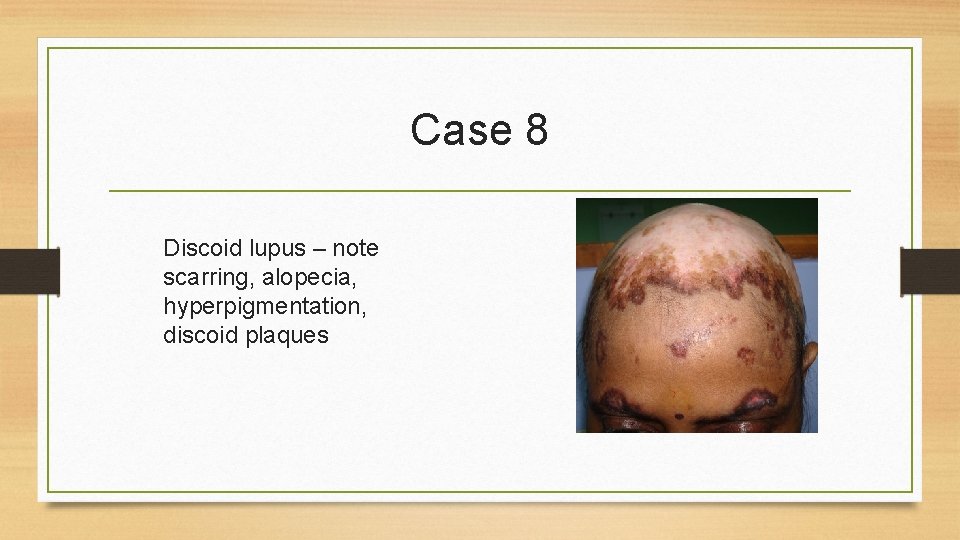 Case 8 Discoid lupus – note scarring, alopecia, hyperpigmentation, discoid plaques 