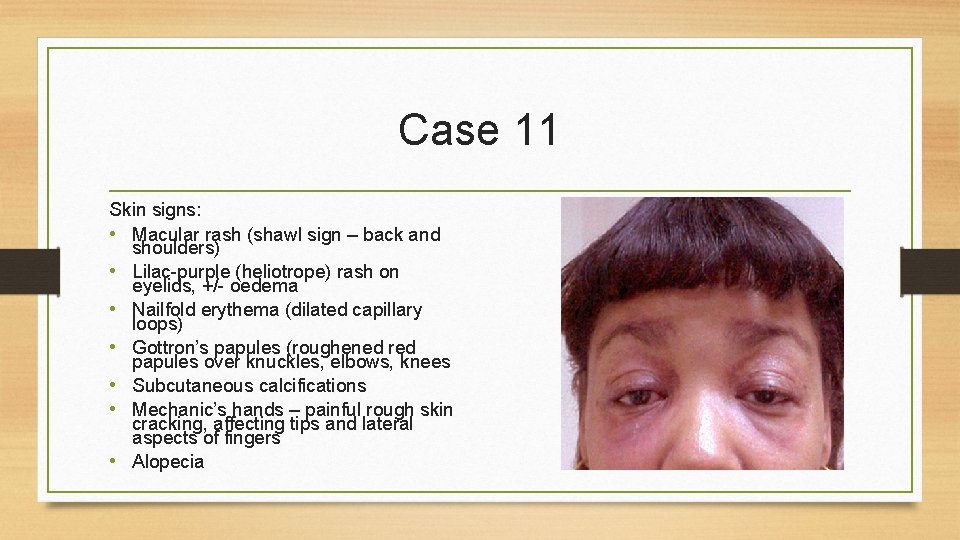 Case 11 Skin signs: • Macular rash (shawl sign – back and shoulders) •