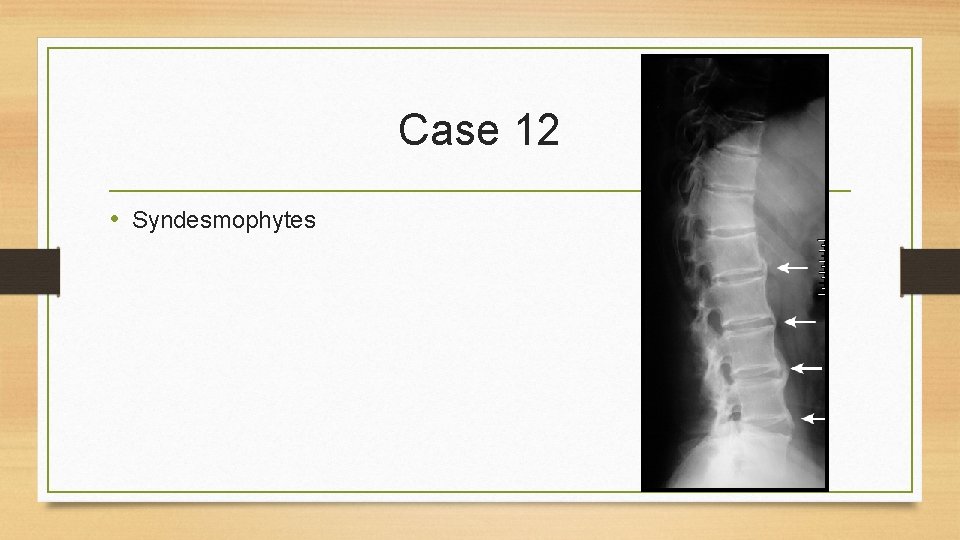 Case 12 • Syndesmophytes 