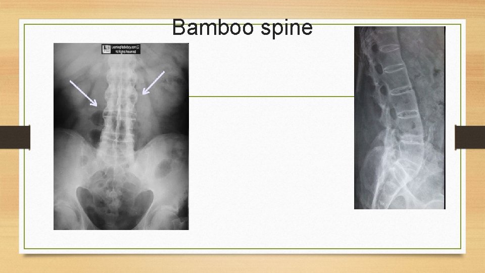 Bamboo spine 