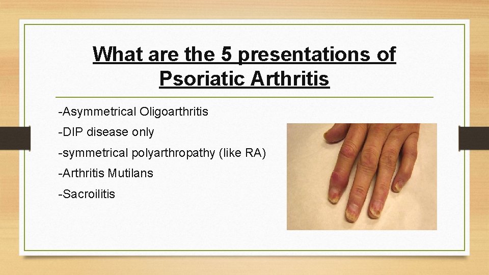 What are the 5 presentations of Psoriatic Arthritis -Asymmetrical Oligoarthritis -DIP disease only -symmetrical