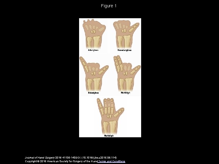 Figure 1 Journal of Hand Surgery 2016 41135 -143 DOI: (10. 1016/j. jhsa. 2015.