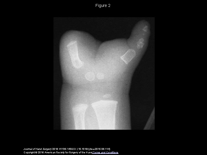 Figure 2 Journal of Hand Surgery 2016 41135 -143 DOI: (10. 1016/j. jhsa. 2015.