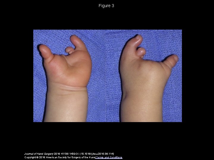 Figure 3 Journal of Hand Surgery 2016 41135 -143 DOI: (10. 1016/j. jhsa. 2015.