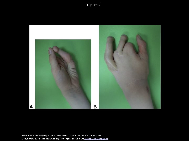 Figure 7 Journal of Hand Surgery 2016 41135 -143 DOI: (10. 1016/j. jhsa. 2015.