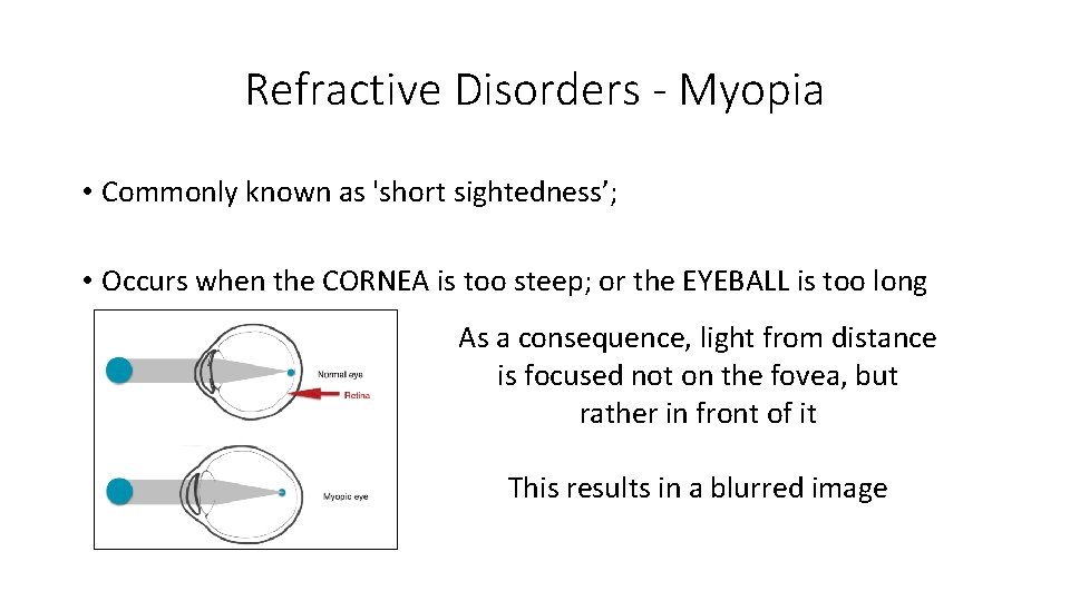 Refractive Disorders - Myopia • Commonly known as 'short sightedness’; • Occurs when the