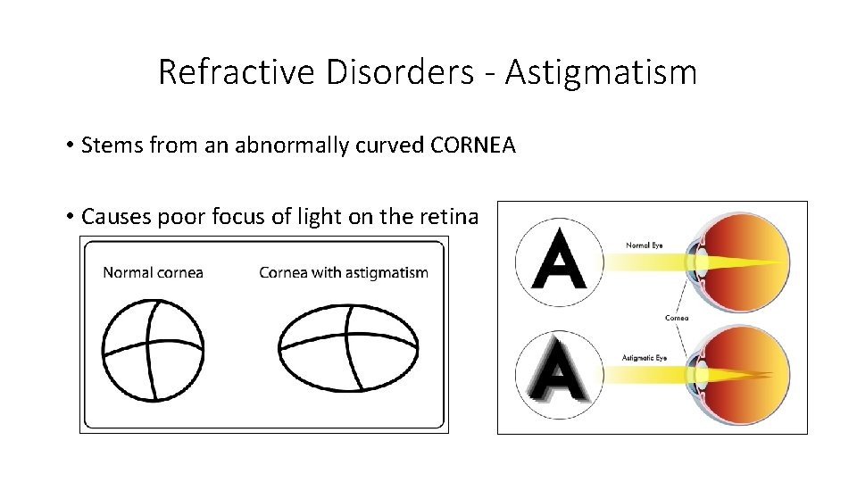 Refractive Disorders - Astigmatism • Stems from an abnormally curved CORNEA • Causes poor