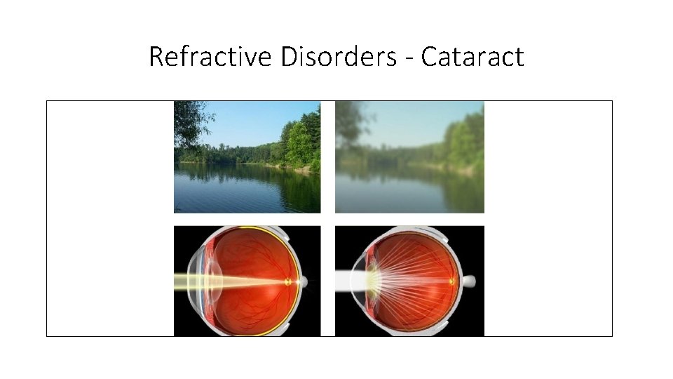 Refractive Disorders - Cataract 