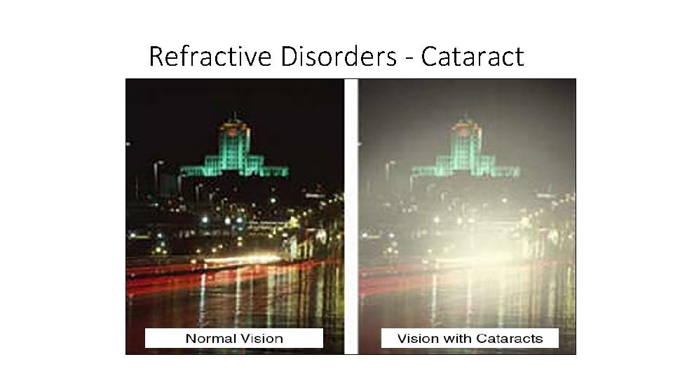 Refractive Disorders - Cataract 