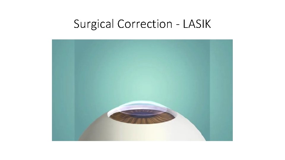 Surgical Correction - LASIK 