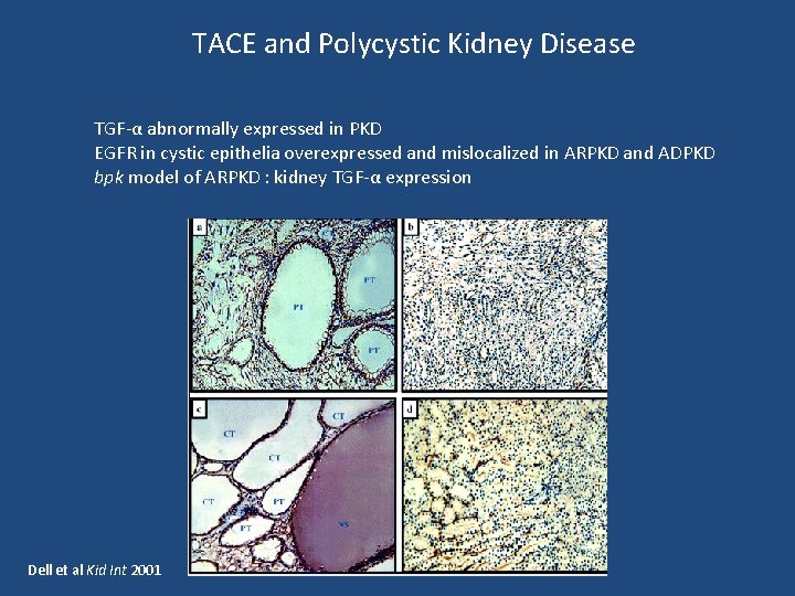 TACE and Polycystic Kidney Disease TGF-α abnormally expressed in PKD EGFR in cystic epithelia