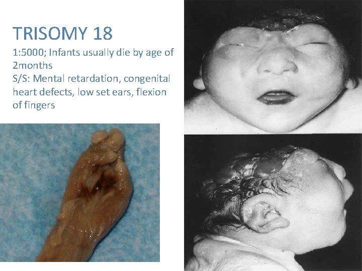  TRISOMY 18 1: 5000; Infants usually die by age of 2 months S/S: