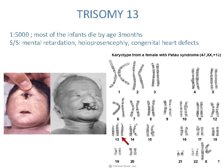 TRISOMY 13 1: 5000 ; most of the infants die by age 3 months