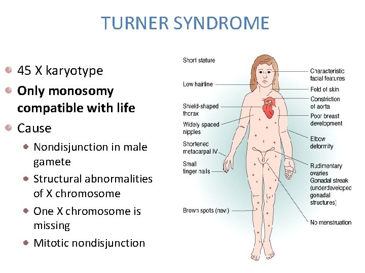 TURNER SYNDROME 45 X karyotype Only monosomy compatible with life Cause Nondisjunction in male