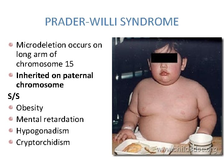 PRADER-WILLI SYNDROME Microdeletion occurs on long arm of chromosome 15 Inherited on paternal chromosome