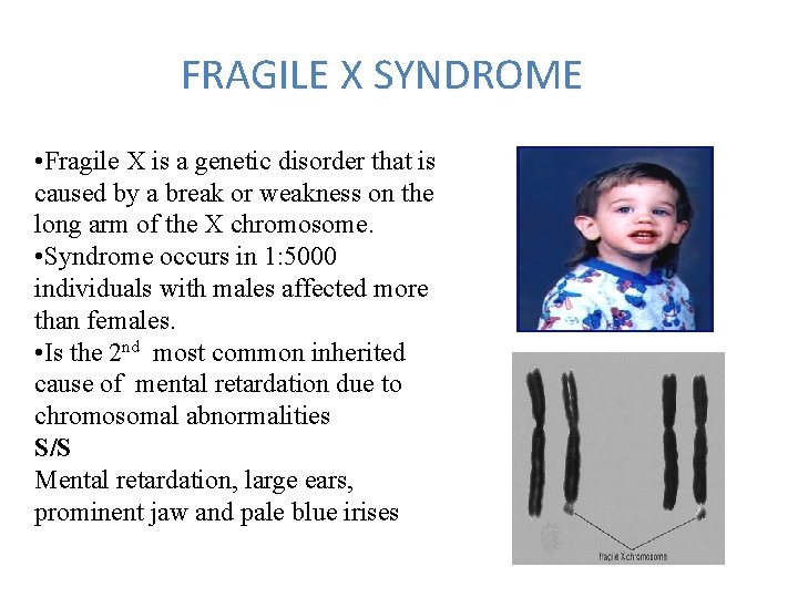 FRAGILE X SYNDROME • Fragile X is a genetic disorder that is caused by