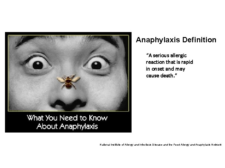 Anaphylaxis Definition “A serious allergic reaction that is rapid in onset and may cause