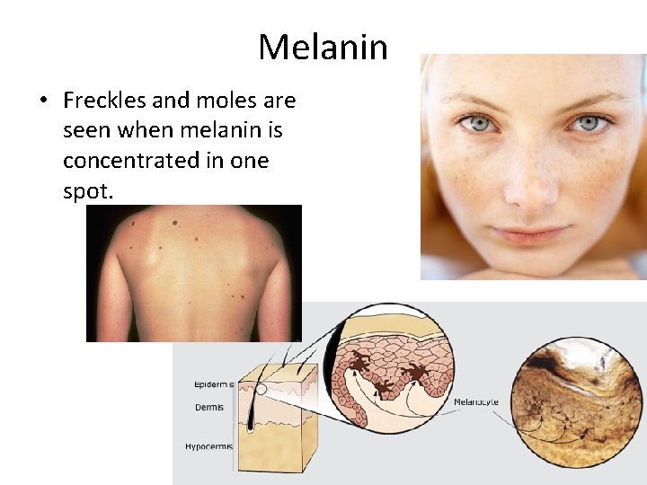 Melanin • Freckles and moles are seen when melanin is concentrated in one spot.