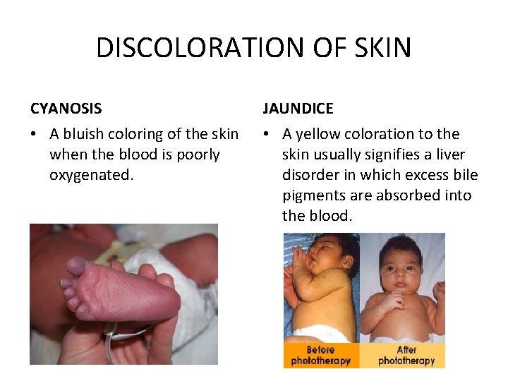 DISCOLORATION OF SKIN CYANOSIS JAUNDICE • A bluish coloring of the skin when the