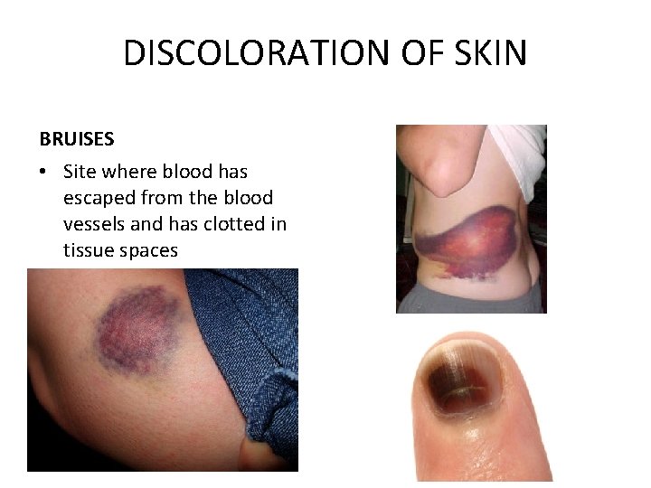 DISCOLORATION OF SKIN BRUISES • Site where blood has escaped from the blood vessels