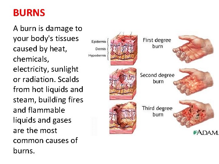 BURNS A burn is damage to your body's tissues caused by heat, chemicals, electricity,