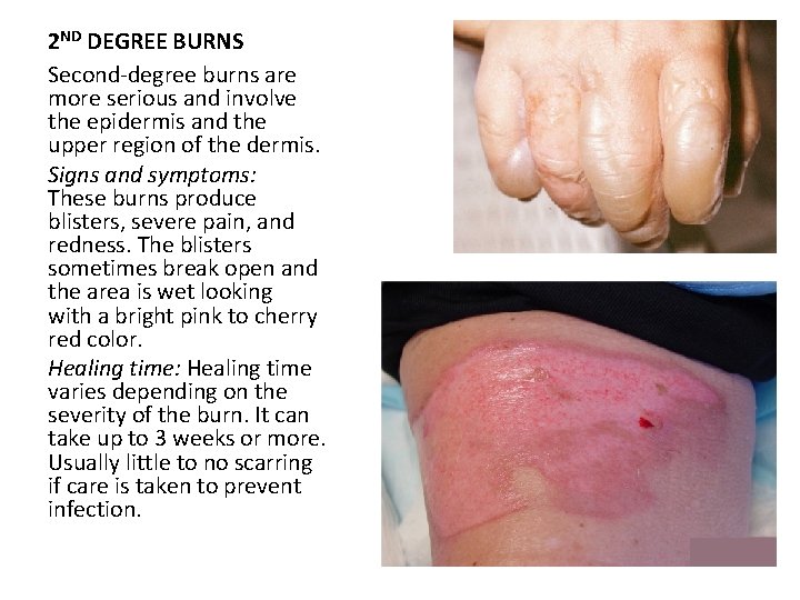 2 ND DEGREE BURNS Second-degree burns are more serious and involve the epidermis and