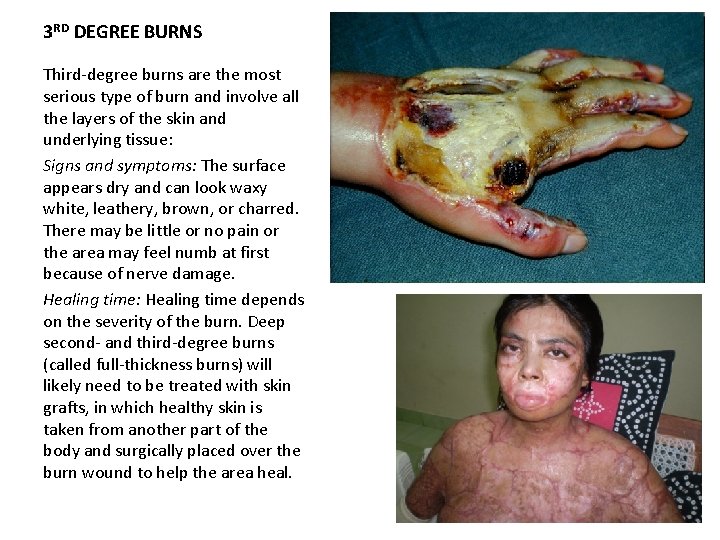 3 RD DEGREE BURNS Third-degree burns are the most serious type of burn and