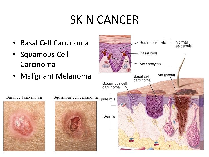 SKIN CANCER • Basal Cell Carcinoma • Squamous Cell Carcinoma • Malignant Melanoma 