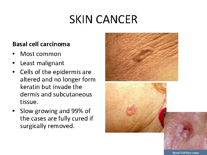 SKIN CANCER Basal cell carcinoma • Most common • Least malignant • Cells of