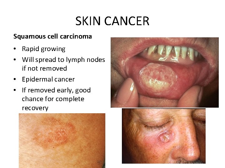 SKIN CANCER Squamous cell carcinoma • Rapid growing • Will spread to lymph nodes