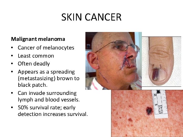 SKIN CANCER Malignant melanoma • Cancer of melanocytes • Least common • Often deadly