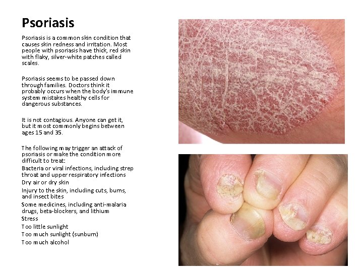 Psoriasis is a common skin condition that causes skin redness and irritation. Most people