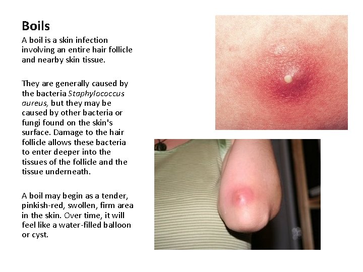 Boils A boil is a skin infection involving an entire hair follicle and nearby