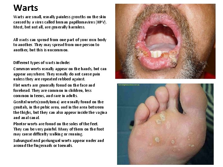 Warts are small, usually painless growths on the skin caused by a virus called