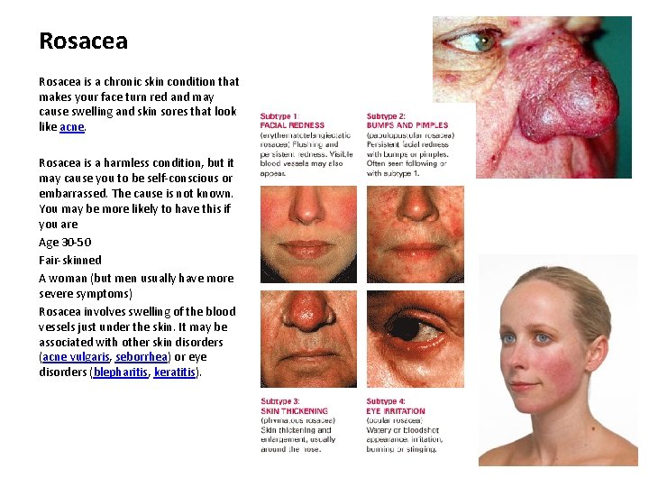 Rosacea is a chronic skin condition that makes your face turn red and may