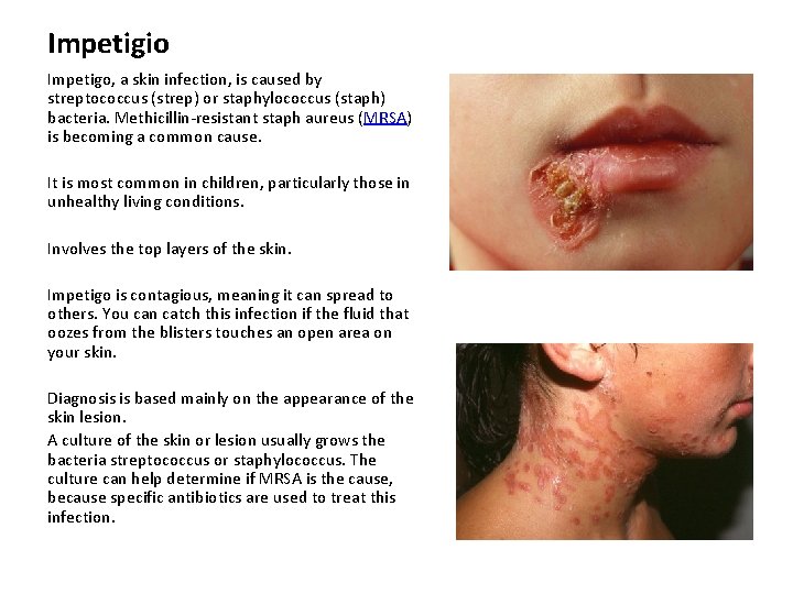 Impetigio Impetigo, a skin infection, is caused by streptococcus (strep) or staphylococcus (staph) bacteria.