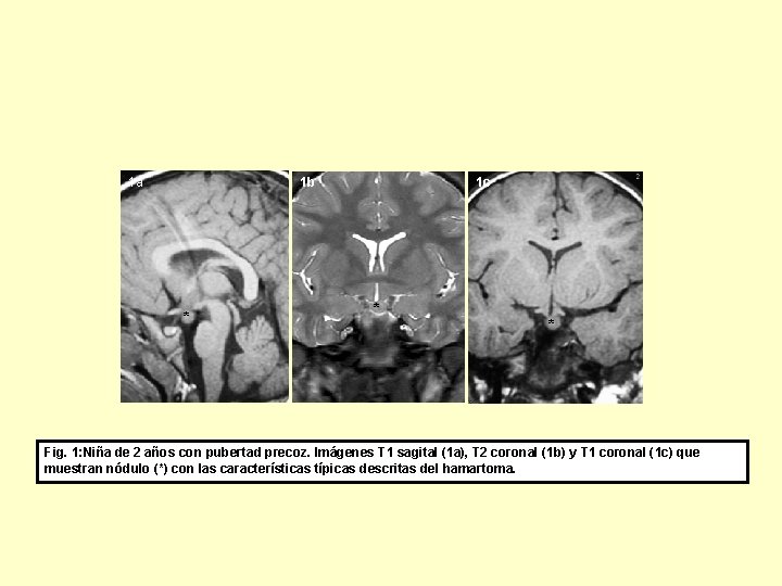 1 b 1 a * 1 c * * Fig. 1: Niña de 2