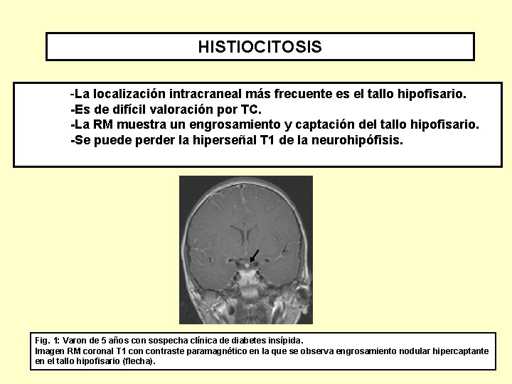 HISTIOCITOSIS -La localización intracraneal más frecuente es el tallo hipofisario. -Es de difícil valoración