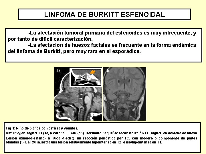 LINFOMA DE BURKITT ESFENOIDAL -La afectación tumoral primaria del esfenoides es muy infrecuente, y