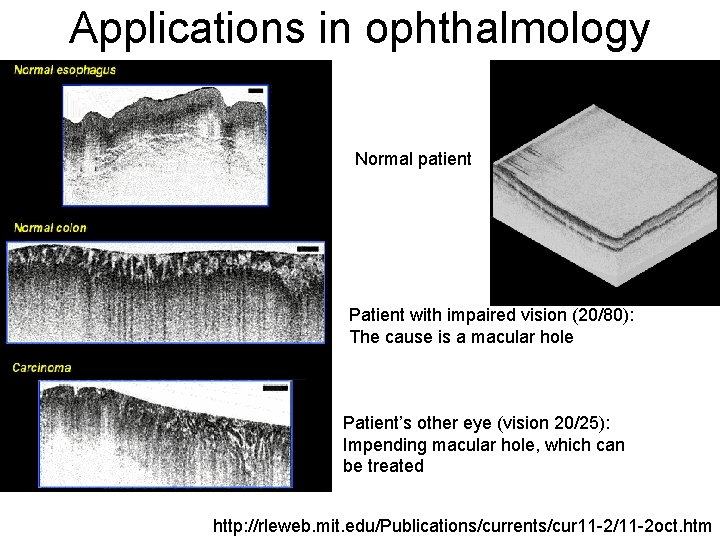 Applications in ophthalmology Normal patient Patient with impaired vision (20/80): The cause is a